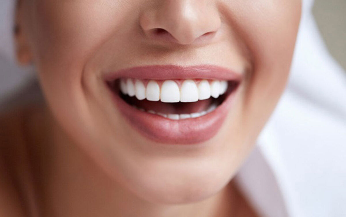 لمینت دندان